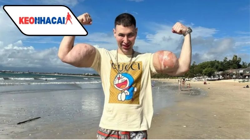 Nghệ sĩ thể hình Nga nguy cơ mất cả hai tay vì lạm dụng hóa chất